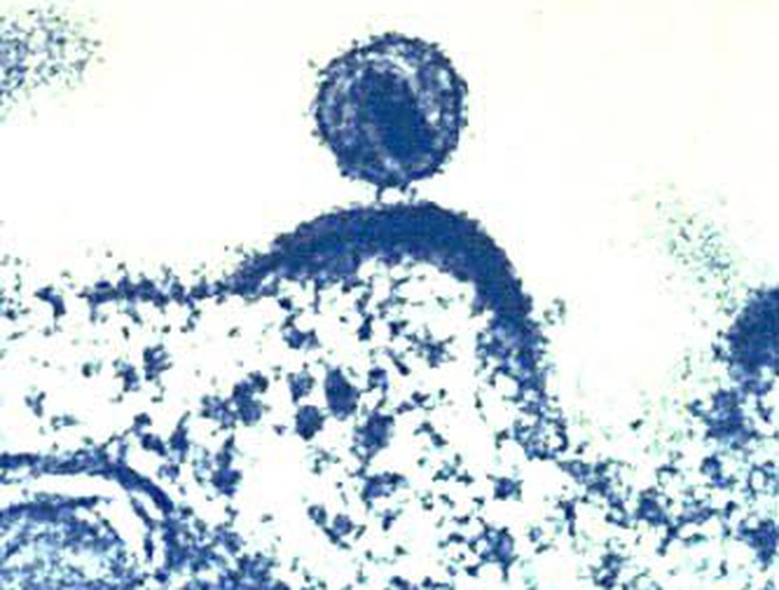 HI-Virus, das sich aus einer Immunzelle herauslöst.
https://de.wikipedia.org/wiki/AIDS#/media/Datei:Hiv_budding.jpg