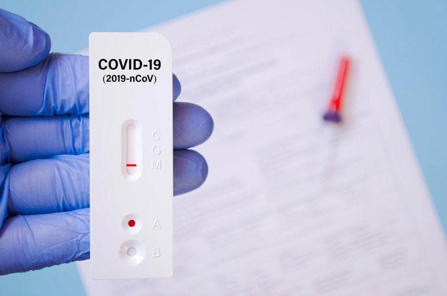 Positives Testergebnis durch den Schnelltest für COVID-19, schnelle Antikörper-Point-of-Care-Tests. Labor, das einen Schnelldiagnosetest auf Antikörper durchführt, um das Vorhandensein von Antigenen C ...