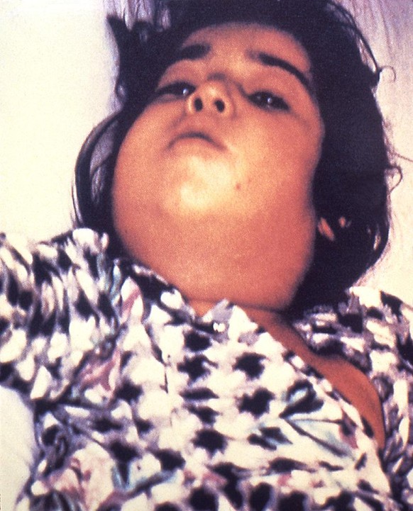 Diphtherie: Kind mit geschwollenem Hals aufgrund der Entzündung. 
https://de.wikipedia.org/wiki/Diphtherie#/media/Datei:Diphtheria_bull_neck.5325_lores.jpg