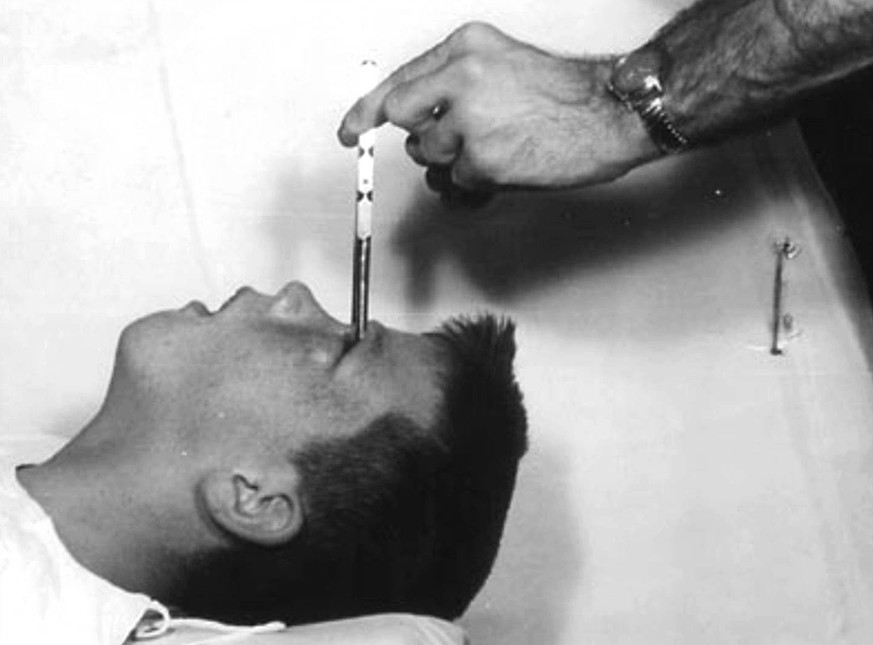 Die Lobotomie am angeblich schizophrenen Howard Dully, 16. Dezember 1960.&nbsp;Seither ist er abgestumpft und interesselos. Für Freeman ein Erfolg.