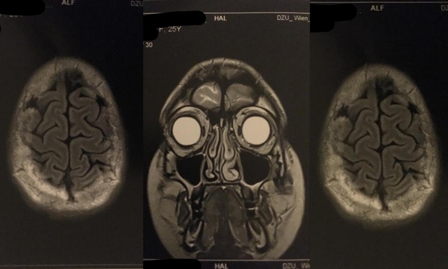 Die Scans von Hannahs Gehirn vor der Operation – der Tumor ist mit blossem Auge nicht zu erkennen.