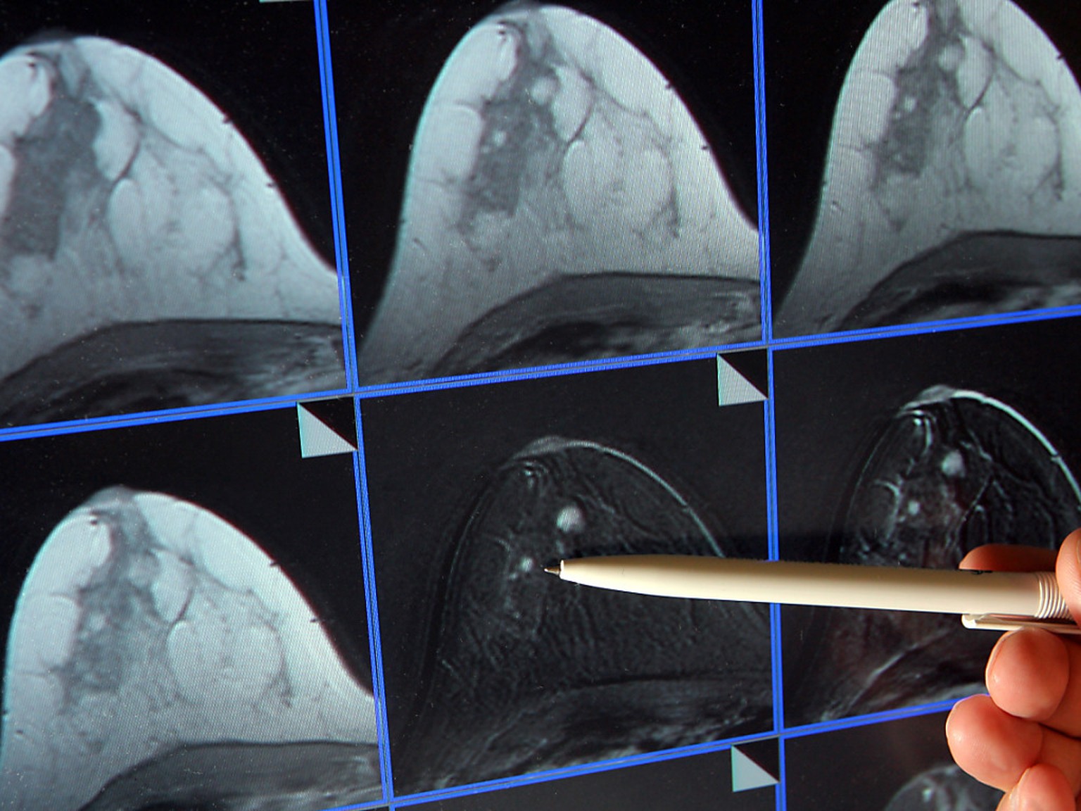 Bildschirmdarstellung einer Magnetresonanz-Mammographie. Dabei ist ein winziger Tumor in der Brust einer Patientin zu sehen. (Archivbild)