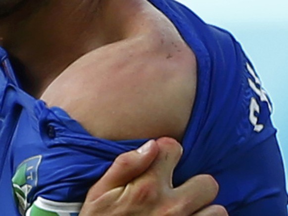 Chiellinis Schulter mit dem Bissabdruck von Suarez.